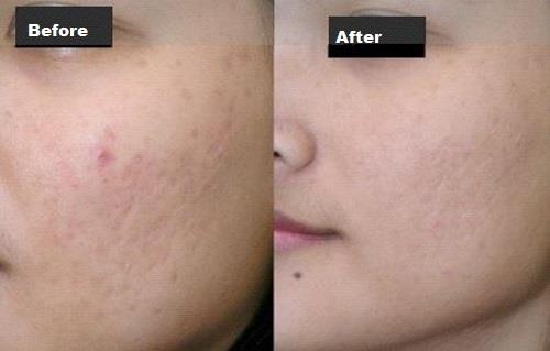 Skin Laser Acne Scar Removal