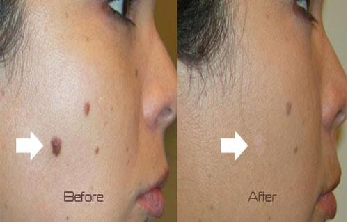 Skin Laser Mole Scar Removal